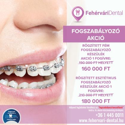 Fogszabályozás Akció Fogszabályozás Akció