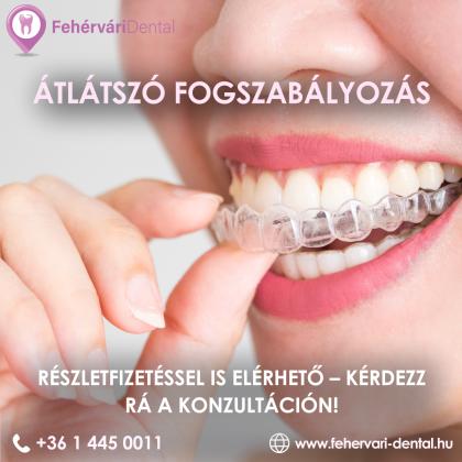 Átlátszó fogszabályozás részletfizetéssel