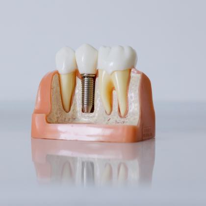 Fogpótlás árak: mennyibe kerül pótolni a hiányzó fogakat?