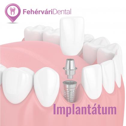 Implantológia